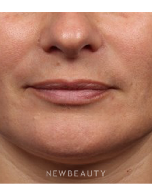 Dr. Kelly Bomer - Lip Fillers - Before