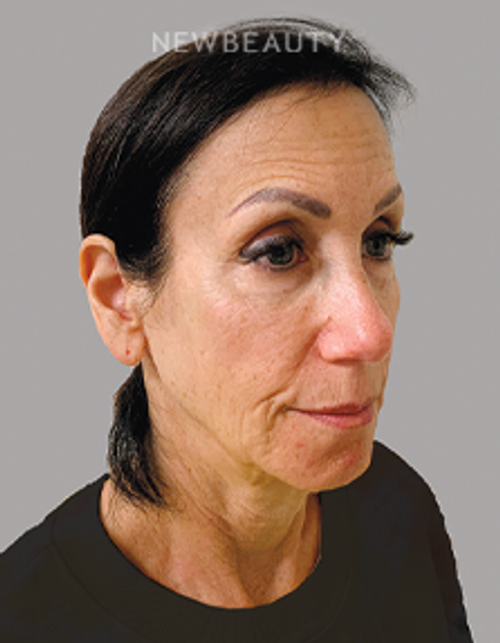 Dr. Doris Day - Natural-looking Rejuvenation - 21597213 - Before