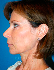 Dr. Kelly Bomer Liquid Facelift - After