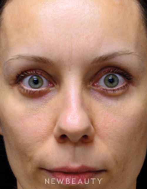 Dr. Mokhtar Asaadi - Eyelift - After