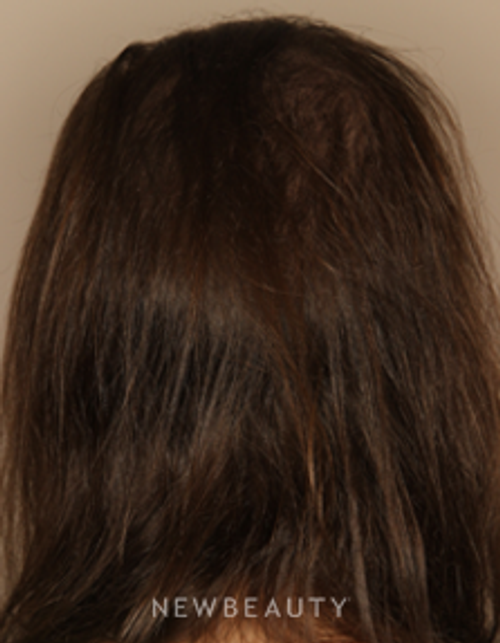 Dr. Doris Day - Hair Loss Treatment - After