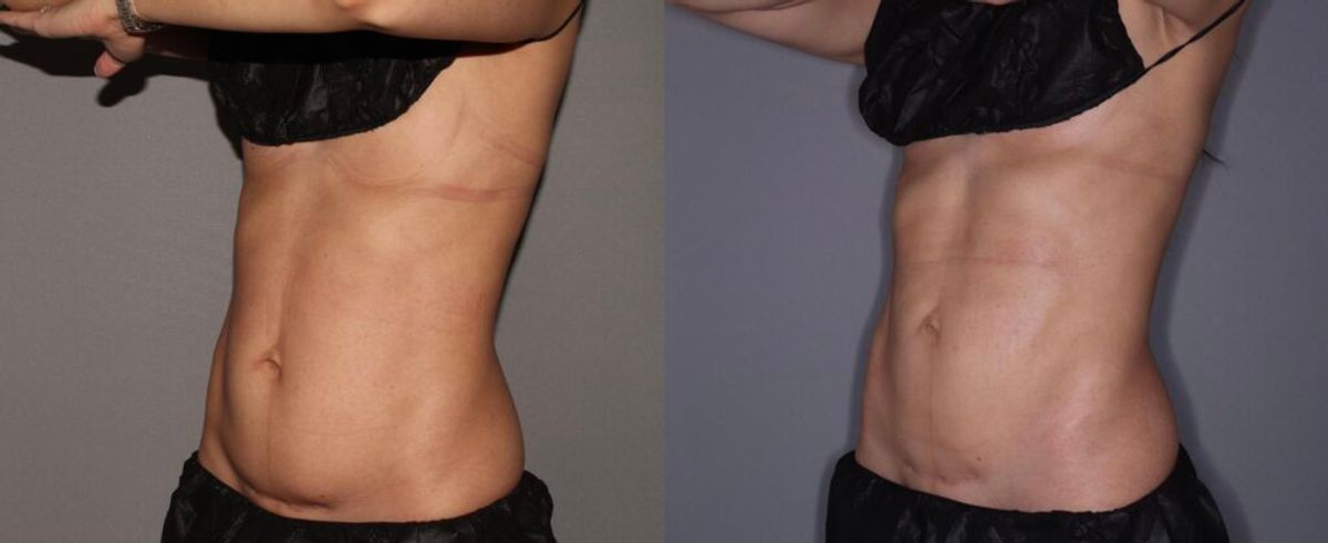coolsculpting-keaney