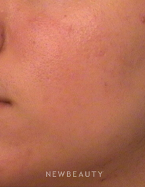 Dr. Tina Alster Lasers, Acne Treatment - After
