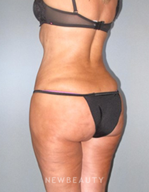 Dr. German Newall - Butt Augmentation - After