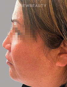 Dr. Anna Chacon - Melasma - 34280278 - After