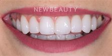 Dr. Nathan Hoffman - Smile Makeover - After