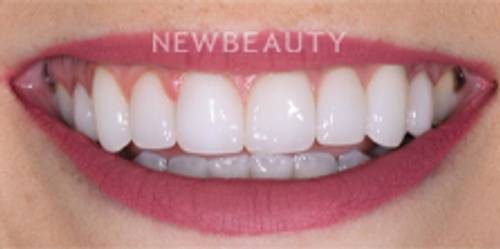 Dr. Nathan Hoffman - Smile Makeover - After