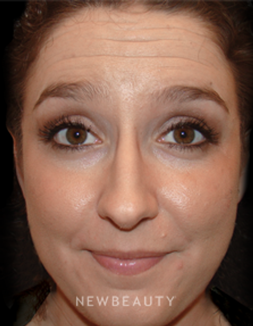 Dr. Joel Schlessinger - Youthful Rejuvenation - Before