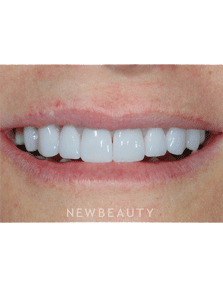 Dr. Guy Lewis Veneers, Gum Lift - After