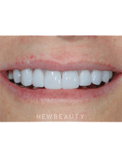 Dr. Guy Lewis Veneers, Gum Lift - After