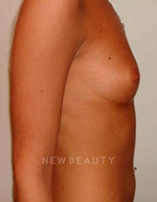 Dr. Michael Horn Saline Breast Implants - Before