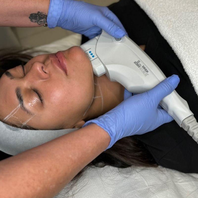 Merz Ultherapy PRIME