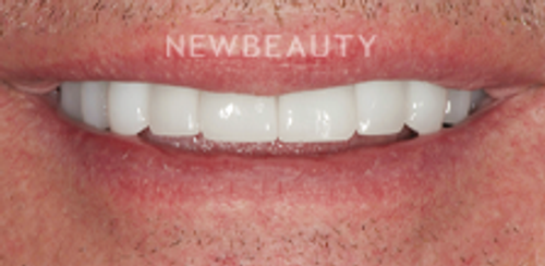 Dr. Salvator La Mastra - Smile Makeover-46106784 - After