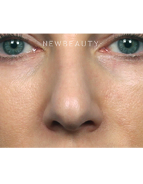 Dr. Kelly Bomer - Nonsurgical Rhinoplasty - After
