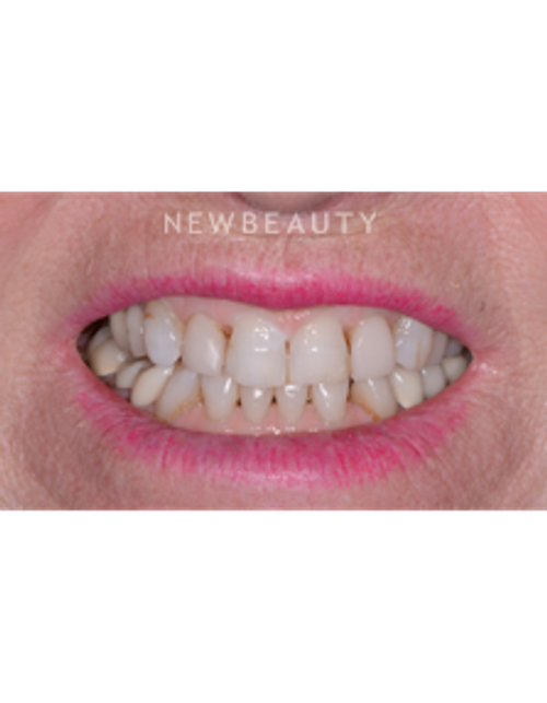 Dr. Irene Grafman - Dental Bonging - Before