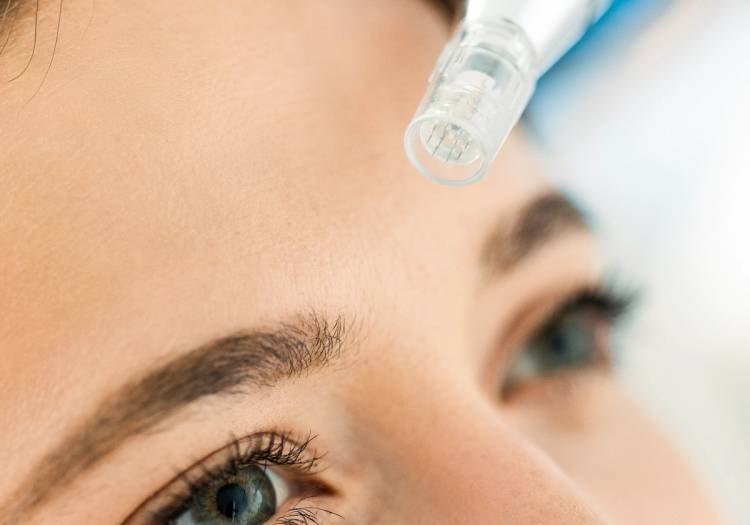 Close-up of a microneedling pen with fine needles positioned near a woman's forehead during a skin treatment