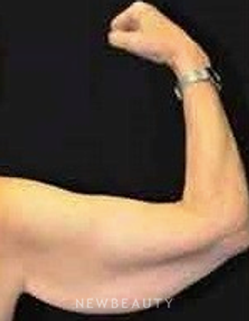Dr. Aviva Preminger - Arm Lift - Before