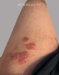 Dr. Anna Chacon – Allergic Dermatitis - 34277948 - Before