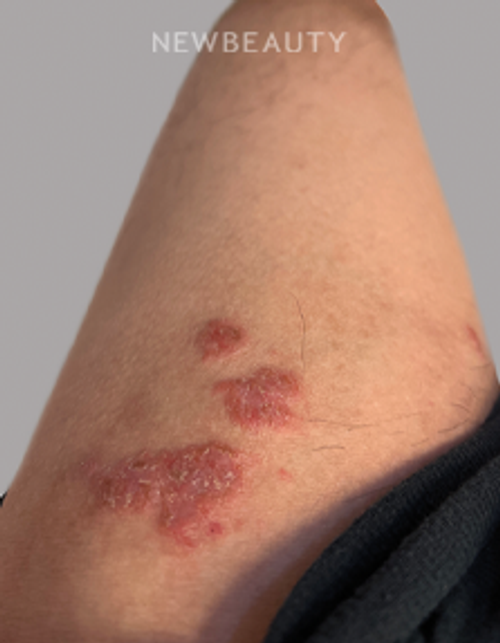 Dr. Anna Chacon – Allergic Dermatitis - 34277948 - Before