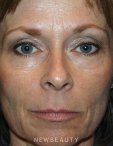 Dr. Kelly Bomer - Fillers - Before