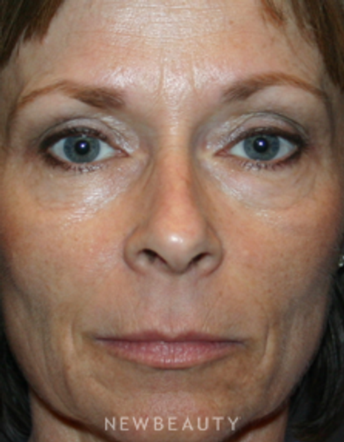 Dr. Kelly Bomer - Fillers - Before