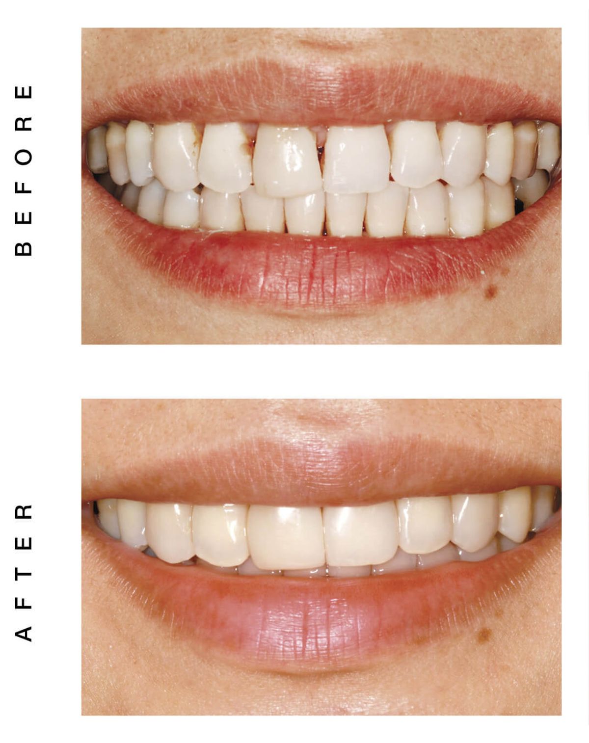 veneer makeover