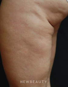 Dr. Kenneth Beer Lasers - Cellulite Treatment - Before