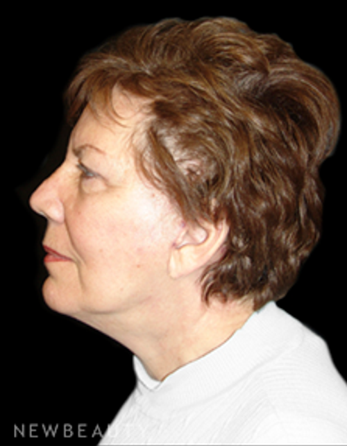 Dr. Mokhtar Asaadi Facelift - After