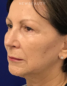 Dr. Dilip Madnani - Liquid Facelift - After