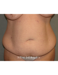 Dr Sean Simon Tummy Tuck, Lipo - Before