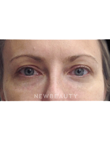 Dr. Julie Russak Injectables & Fillers - After