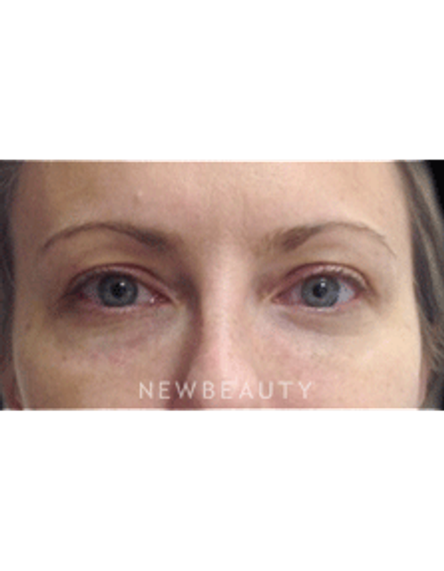 Dr. Julie Russak Injectables & Fillers - After