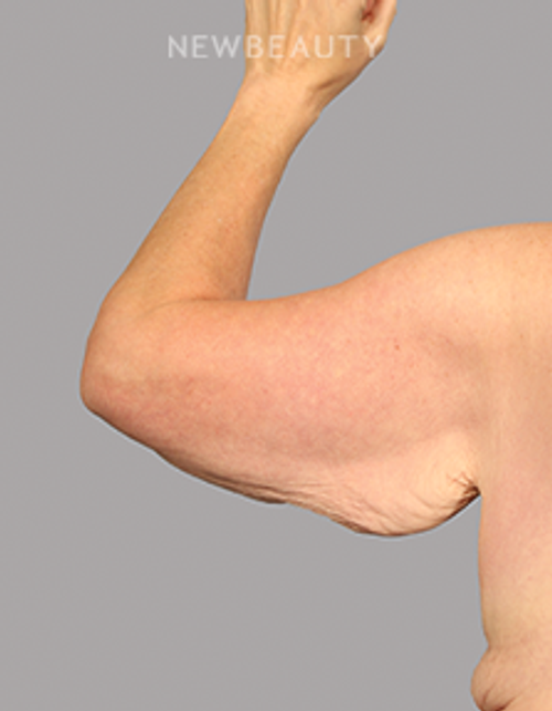 Dr. Mahabir - Arm Lift - 20638033 - Before