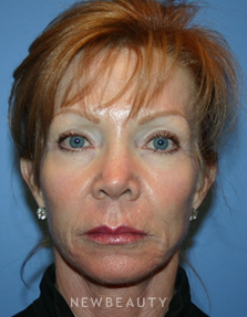 Dr. Kelly Bomer-Liquid Facelift - Before