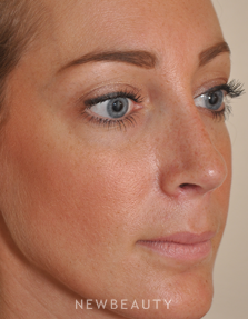 Dr. Edward S. Kwak - Revision Rhinoplasty - After