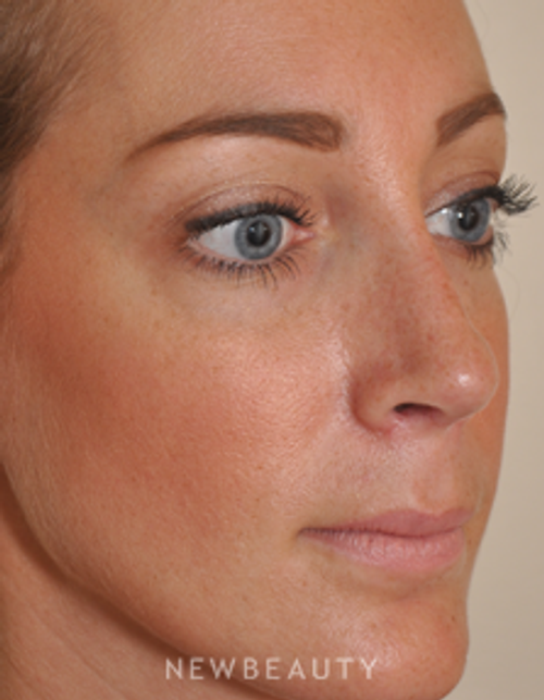 Dr. Edward S. Kwak - Revision Rhinoplasty - After