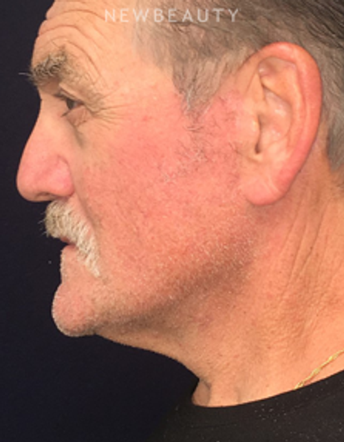 Dr. Kirk Churukian - Facelift with Fat Transfer - After