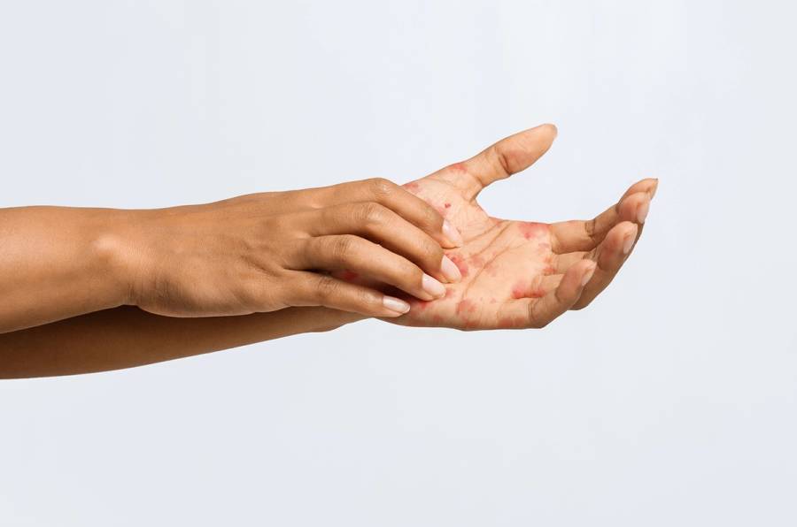eczema