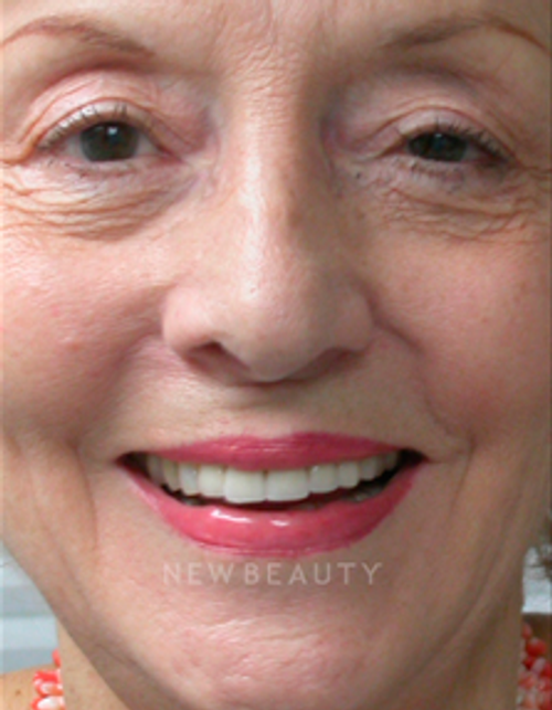 Dr. Irene Grafman Teeth Whitening - After