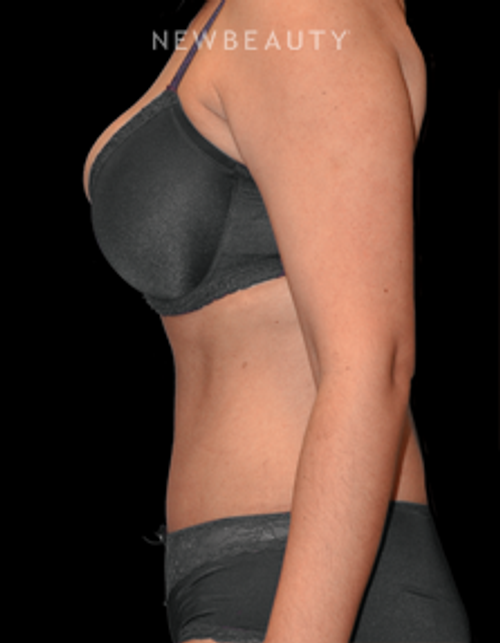 Dr. Bryan W. Gawley - Dramatic Improvement - After