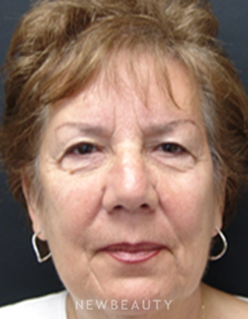Dr. Mokhtar Asaadi Eyelid Lift, Facelift, Necklift - Before