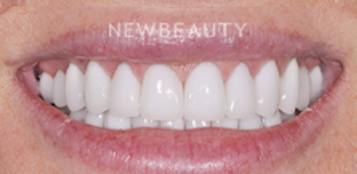 Dr. Salvator La Mastra- Smile Makeover -46106796 - After