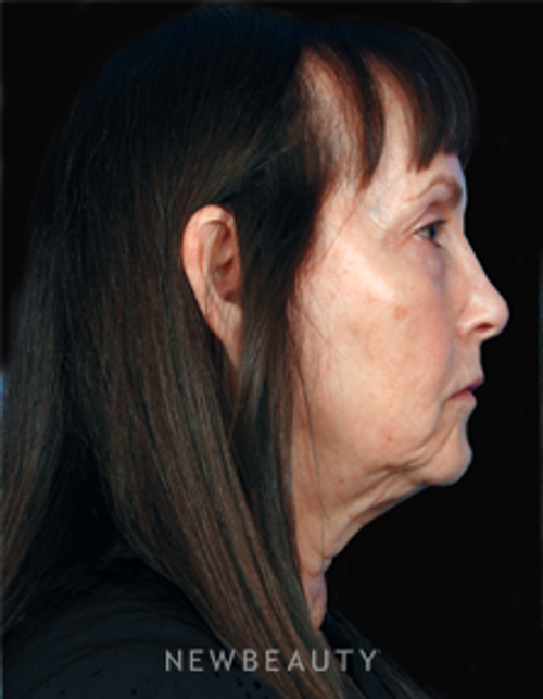 Dr. Kelly Bomer Facelift - Before