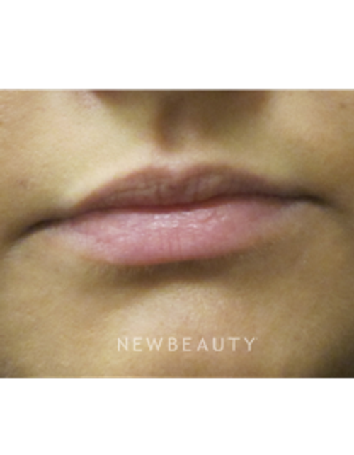 Dr. Jody Levine - Lip Filler - Before