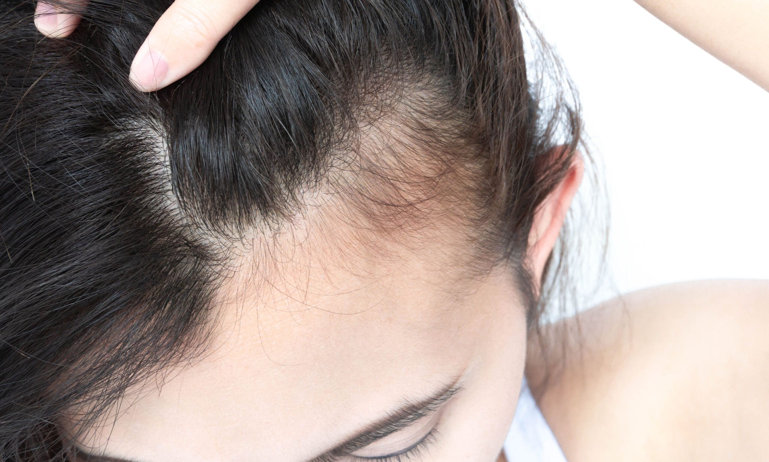 postpartum hair loss