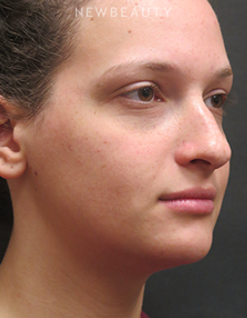 Dr. Elie Levine - Liposuction - Before