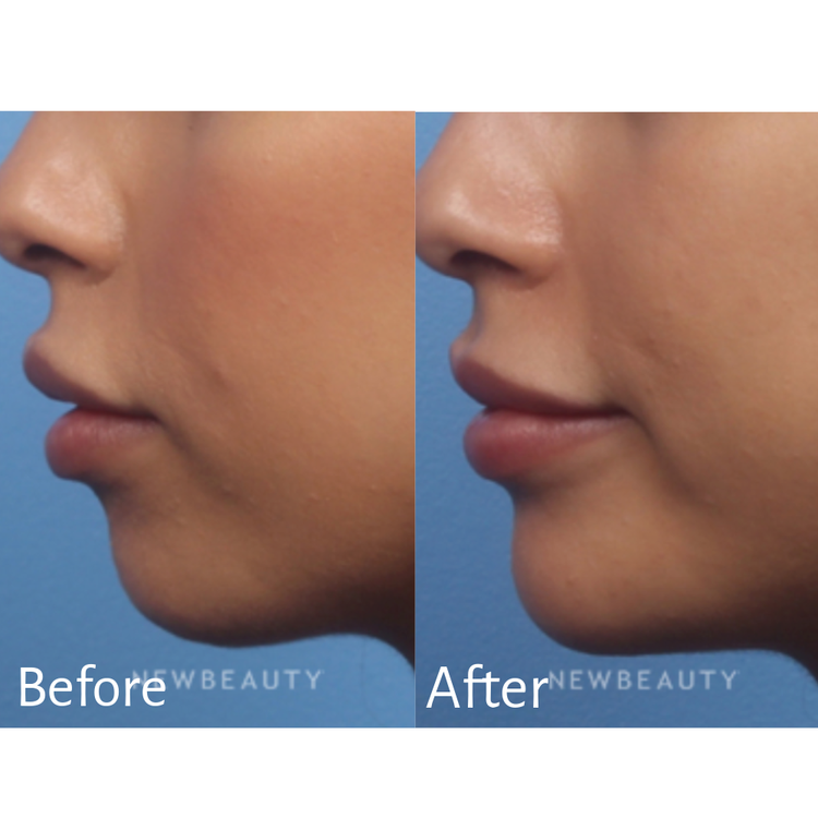 Subtle Contour