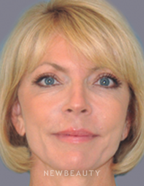 Dr. Alan Durkin Facelift with Fat Transfer - After