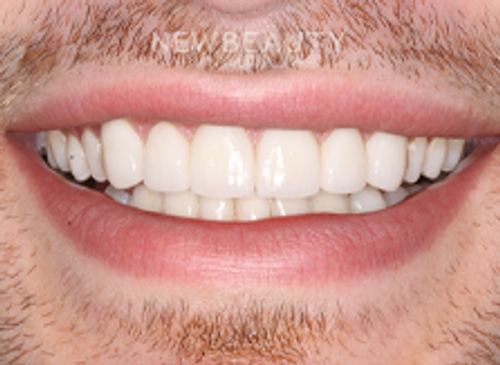 Dr. Joe Kravitz - Veneers - 41419220 - After