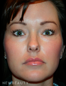Dr. Kelly Bomer Eyelid Lift - After